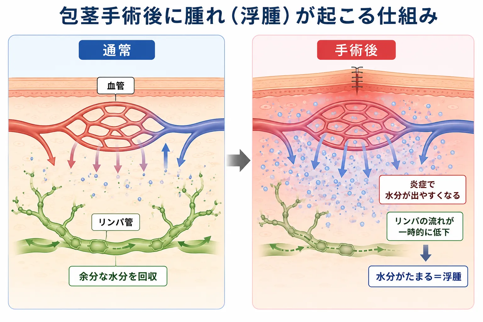 包茎手術後の腫れはいつまで？｜正常なむくみと受診の目安を医師が解説